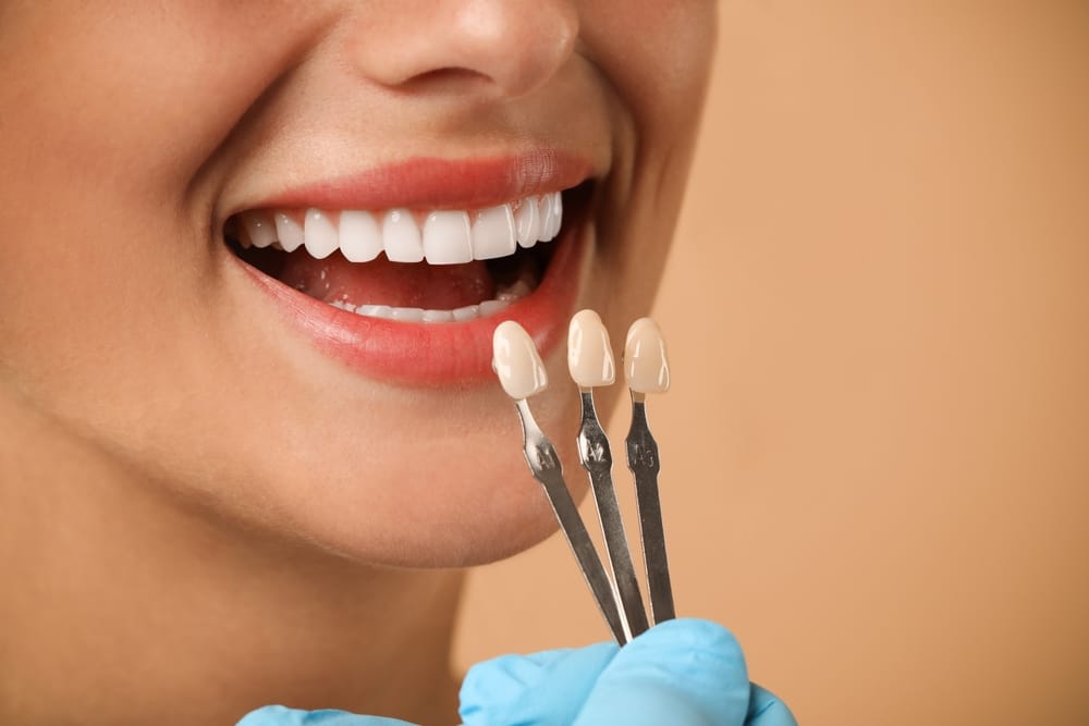 What Cosmetic Veneers Actually Feel Like: 1 Week, 1 Month, 1 Year Later