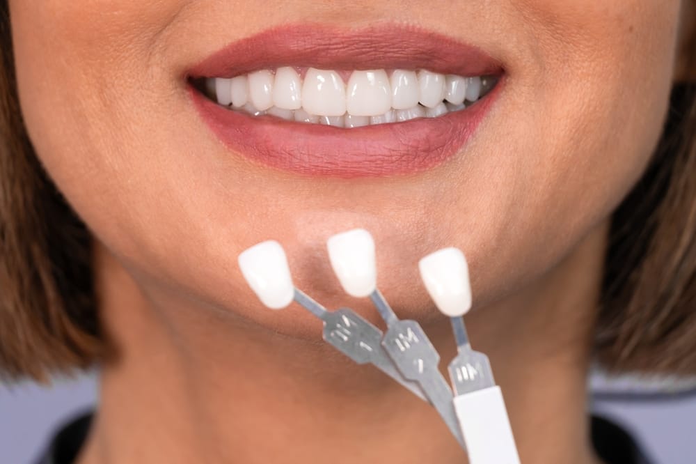Dental Veneers For Missing Teeth In Front Vs. Back: Does it change the answer?